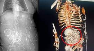 'Grávida' há mais de 50 anos, idosa descobre feto calcificado em abdômen