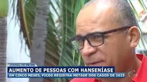 Casos de hanseníase crescem em Picos em comparação a 2023